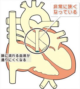 肺動脈狭窄